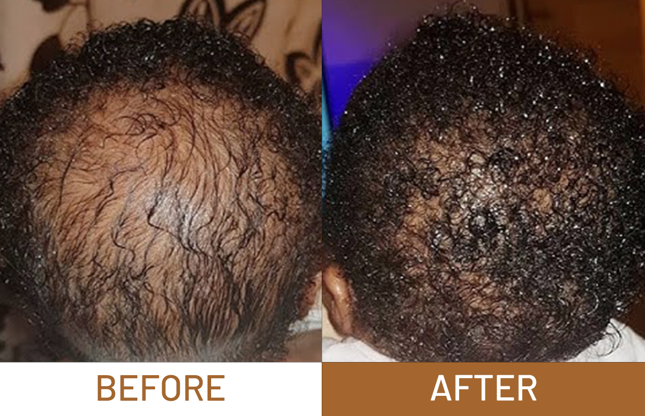 Hair Growth Pure Batana Oil+ Free Derma Roller