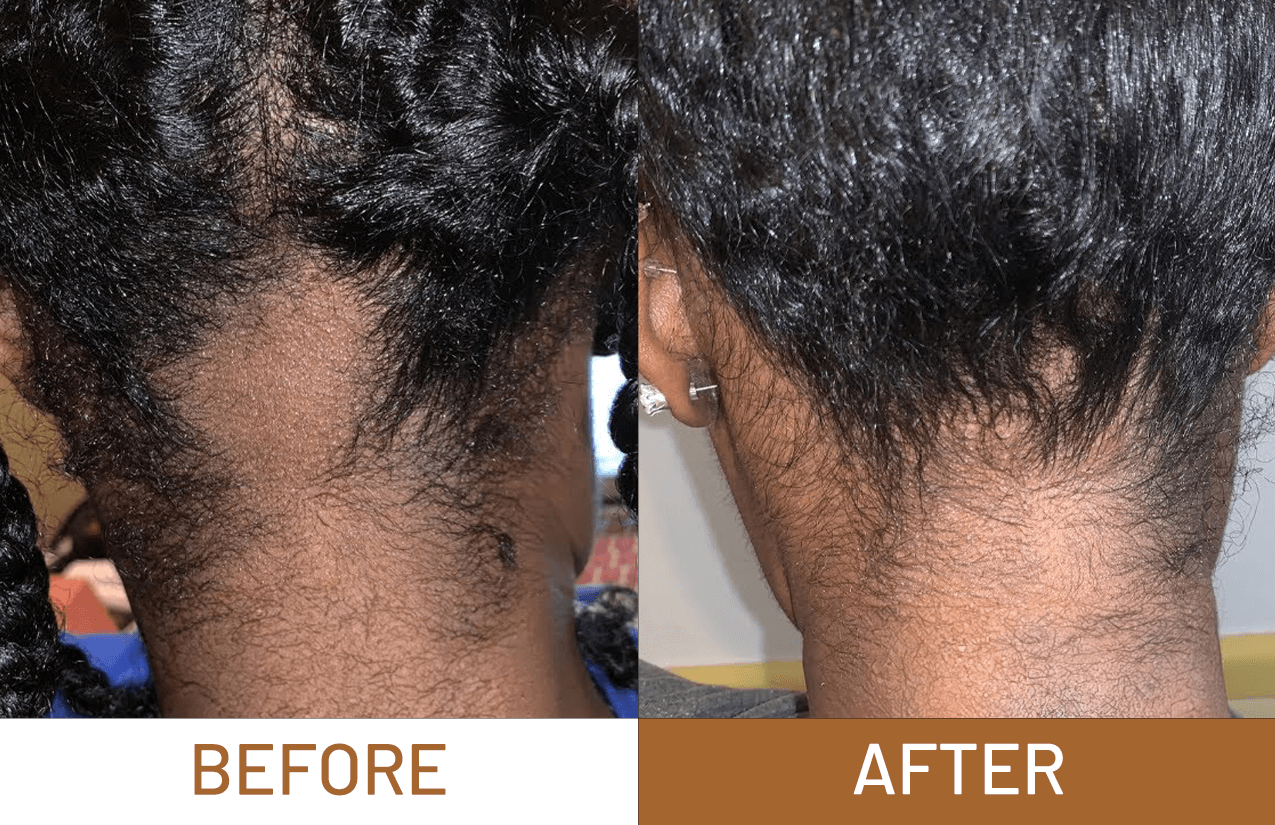 Hair Growth Pure Batana Oil+ Free Derma Roller