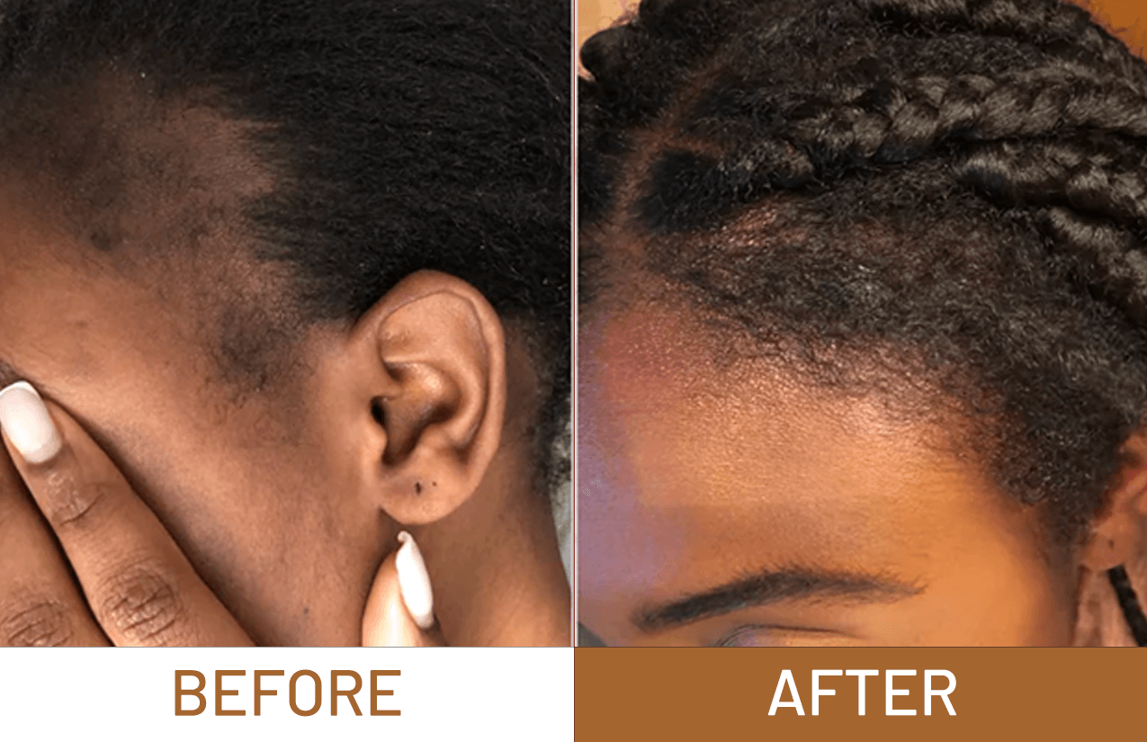 Hair Growth Pure Batana Oil+ Free Derma Roller