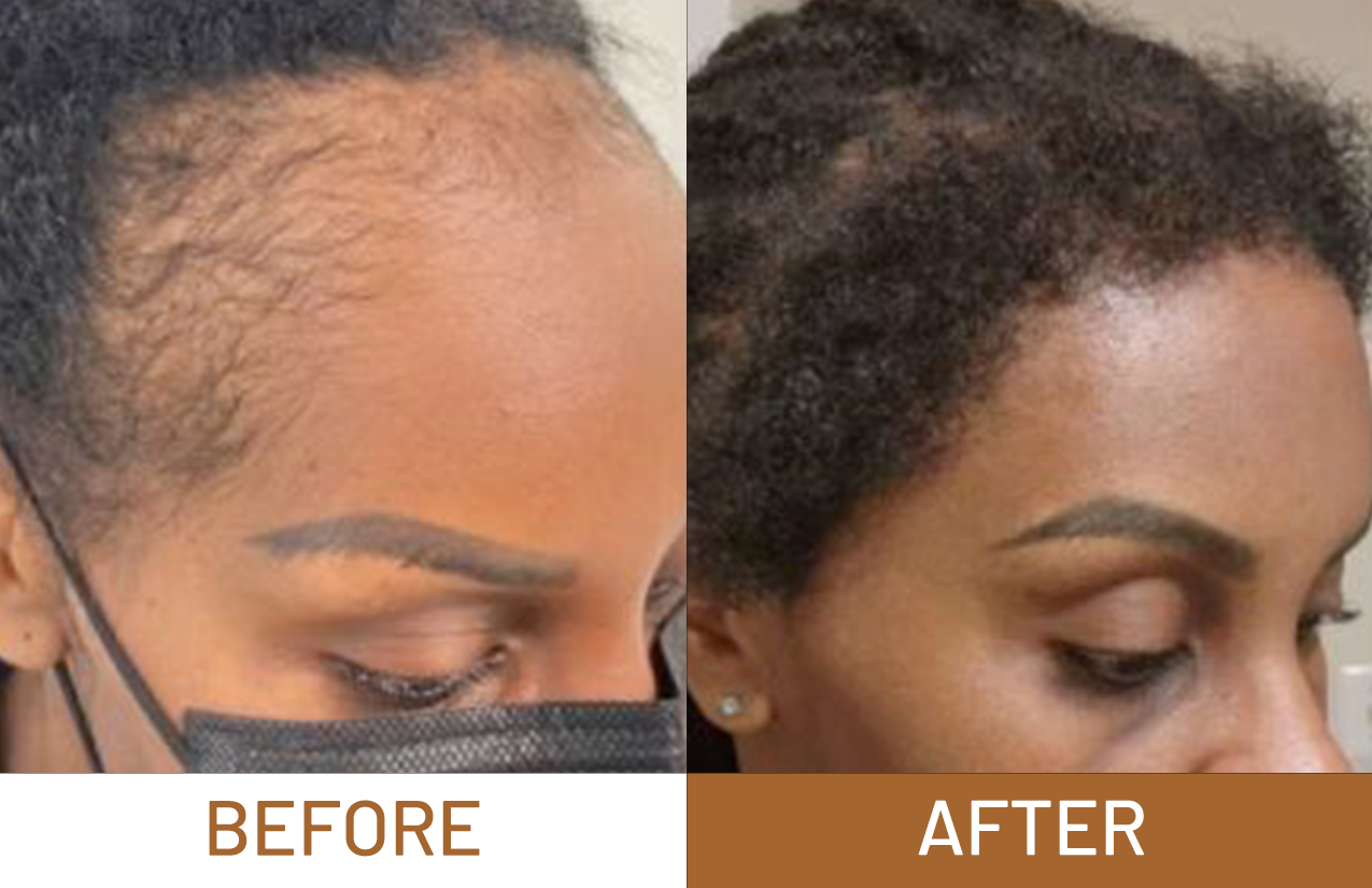 Hair Growth Pure Batana Oil+ Free Derma Roller