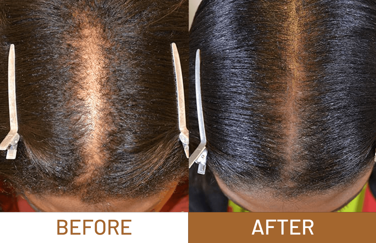 Hair Growth Pure Batana Oil+ Free Derma Roller