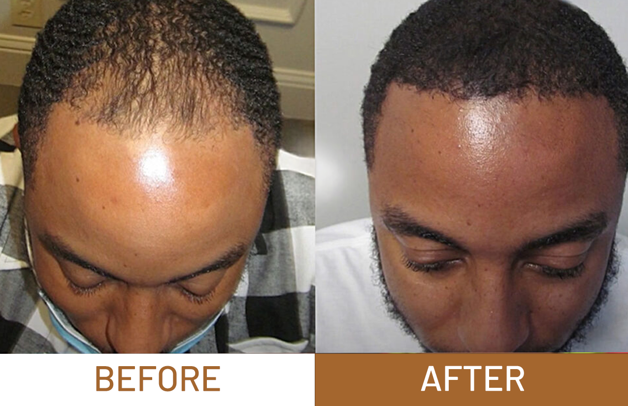 Hair Growth Pure Batana Oil+ Free Derma Roller