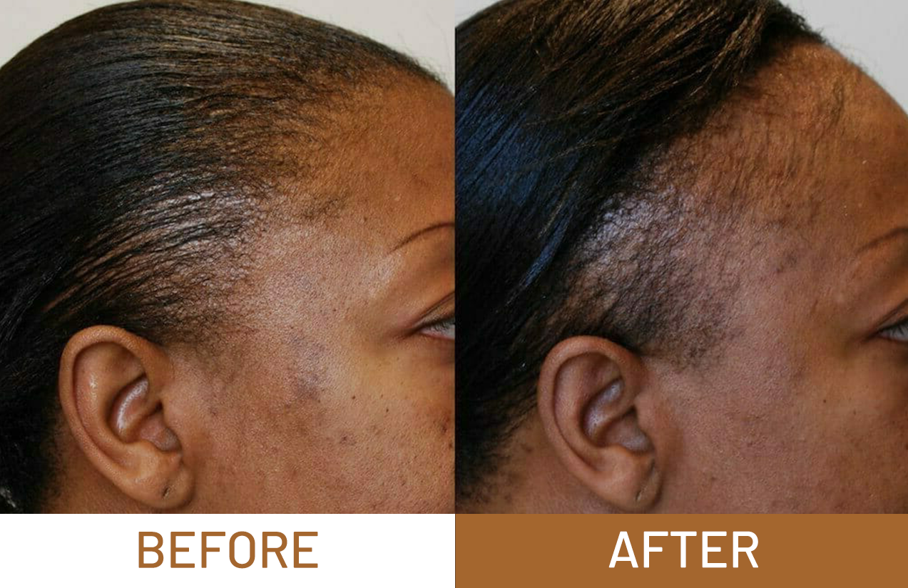 Hair Growth Pure Batana Oil+ Free Derma Roller