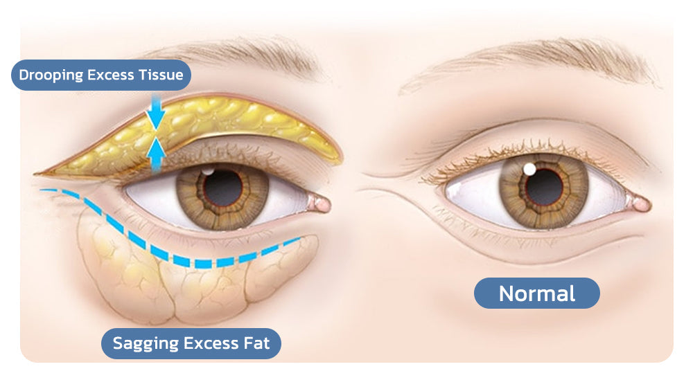 Openeyes Renewal Eye Cream – 33% OFF (Limited Time Only)